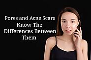 Pores vs. Acne Scars, Know The Differences Between Them