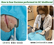 How is Scar Excision performed at OC MedDerm Dermatology?