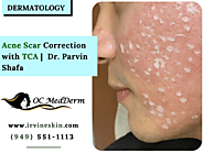Acne Scar Correction with TCA | OC MedDerm