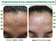 Surgical Extraction of Acne, whitehead and blackhead removal
