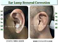 Ear Lump Removal Correction | Earlobe Repair