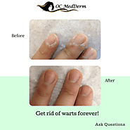 Get rid of warts forever at OC MedDerm Medical Dermatology Clinic
