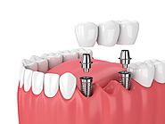 What are Mini Dental Implants? Its Benefits, Indication, Contraindication and Care. - Tricky Care