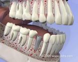 Dental Implants Surgery, Dentists, Dental plan, Denture