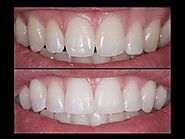 Top 4 Benefits of Dental Bonding for Imperfect Teeth - dentistryondusk | dental | Vingle, Interest Network