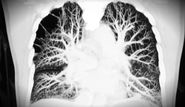 Pulmonary Embolism - St. Louis Medical Malpractice Lawyers