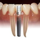 What Is a Dental Implant?