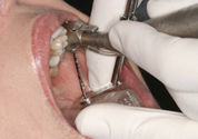 Guided implant surgery: Making sure dental implants are safe, predictable, and efficient