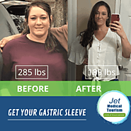 Gastric sleeve before and after