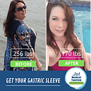 Gastric sleeve before and after