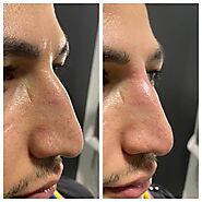Get the best Non-Surgical Nose Job in Toronto for Great Prices