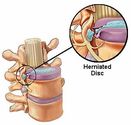 Herniated Disc - Pinched Nerve - Car Accident Attorney