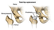 Hip Replacement Surgeon in Kothrud Pune | Total Hip Replacement Doctors in Kothrud Pune | Dr. Pankaj Gunjal