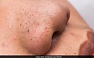 How to Remove Blackheads from Nose: 5 Natural Masks and Scrubs - NDTV Food