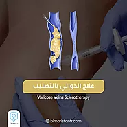 علاج الدوالي بالتصليب-طريقة علاج دوالي الساقين بالحقن - بيمارستان