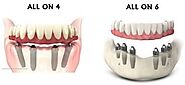 What Is Better Is It All on Four or All on Six Dental Implants