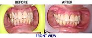 Smile Makeover in Ahmedabad – Case of the Month