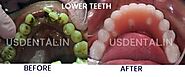 What is the best treatment option for a loose tooth?