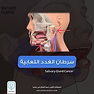 علاج سرطان الغدد اللعابية - بيمارستان