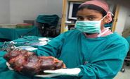 Weighing 2.75 kg world’s largest kidney removed from a patient