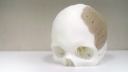 Welcome to the Future: 75% of Man's Skull Replaced by 3D-Printed Implant