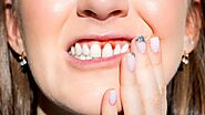 What You Should Know About Bleeding Gums?