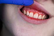 Guarding Your Grin: A Comprehensive Guide on Preventing Gum Disease