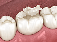 Understanding the Process: Crucial Facts Before Getting a Tooth Filling