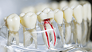 Know the Signs: Do You Need a Root Canal?