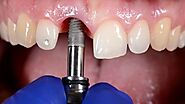 Experience Best Dental Implants in Burlington