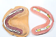 Denture Stabilisation, Dental Implants, Teeth Implants Melbourne | Lentini Dental