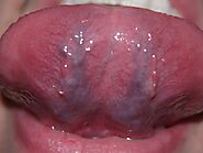 What is Caviar Tongue? Its Causes, Common Sites, Treatment and FAQs - Tricky Care
