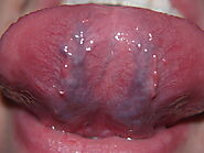 Caviar tongue - Wikipedia