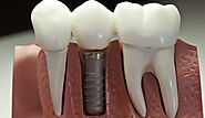 Ipswich dental implants Ipswichdentist