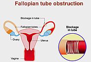 Fallopian Tube Treatment At Regency International Clinic