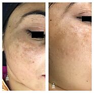 Can pigmentation be treated?