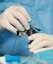 Laparoscopic Fertility Enhancing Surgery in Agra– Dr.Shubhra Goyal