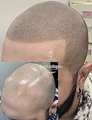 Shape Your Hairline The Way You Want It!