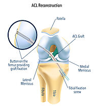 Website at https://www.orthosport.in/service/acl-surgery-in-gurgaon/