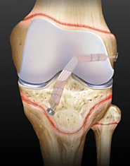 Pediatric ACL Repair Surgery in Gurgaon, Jodhpur, Mumbai, Bangalore