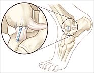 Website at https://www.orthosport.in/service/ankle-ligament-tear/