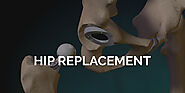 Total Hip Replacement Surgery in Gurgaon, Jodhpur, Mumbai, Bangalore