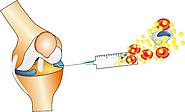 Knee Meniscus Tear Treatment Gurgaon