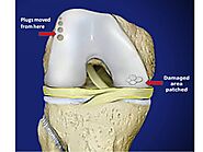 Knee Osteochondritis Dissecans (OCD) Gurgaon, Mumbai, Jodhpur, Bangalore