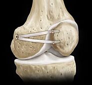 Best MPFL Ligament Surgery in Mumbai