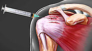 best arthroscopic rotator cuff repair doctor in gurgaon