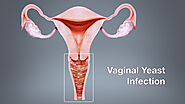 Vaginal Yeast Infection - Symptoms, Causes, and Treatment