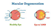 Macular Degeneration - Symptoms, Causes, and Treatment