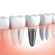 Dental Implants London, ON | Highly Rated Dental Implant Dentist