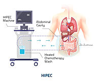 Get the Best HIPEC Cancer Treatment in Ahmedabad